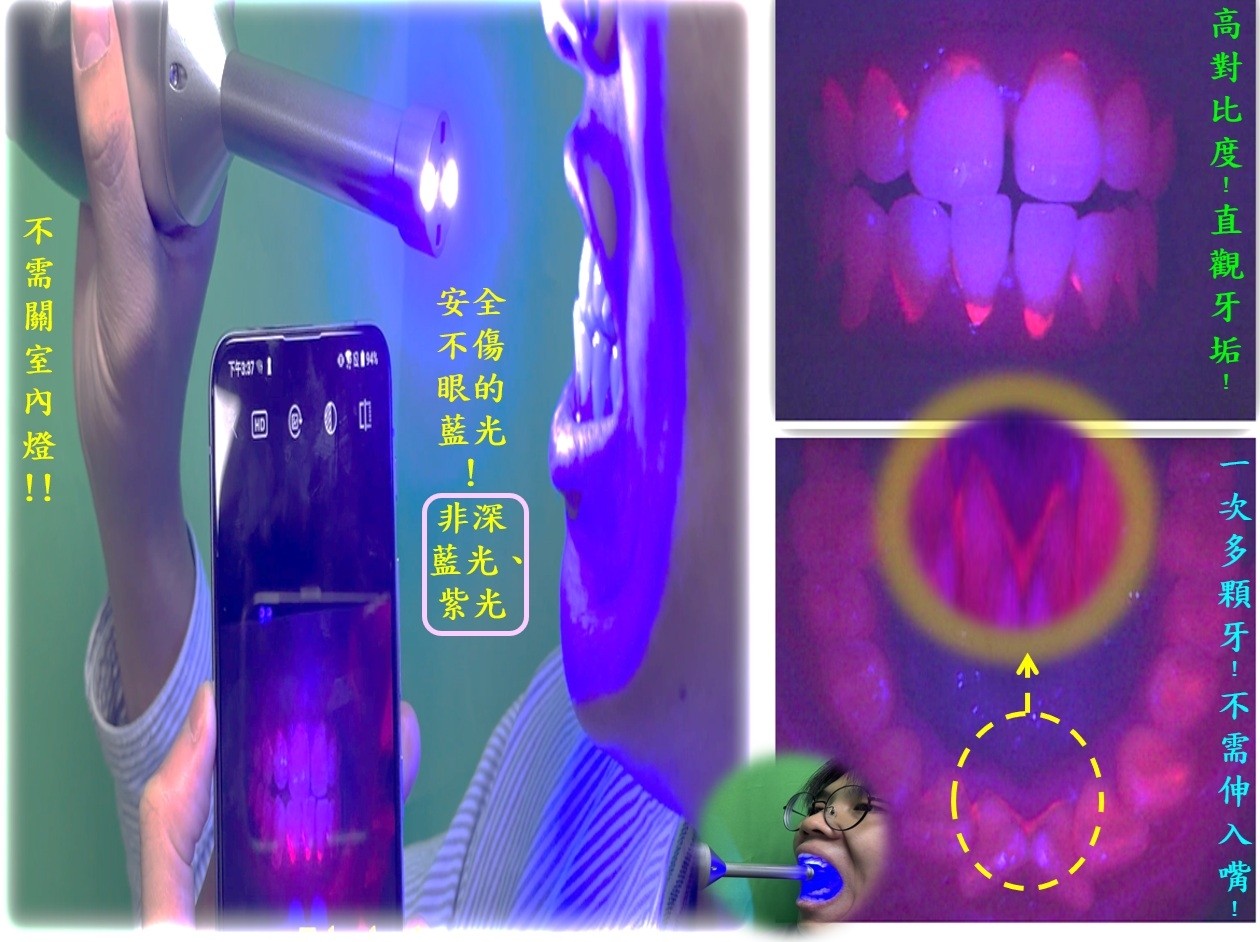 圖1:「牙垢診斷病歷魔法棒」具安全性、操作簡易快速，讓原本透明不易看的牙垢(含牙菌斑與牙結石)可清楚直觀。
